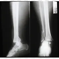 骨折的小腿x光图像