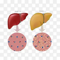 正常肝脏和脂肪肝对比图