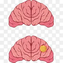 人类大脑疾病对比