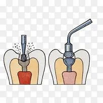 牙根手术插图