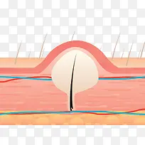 皮脂结构医学插图