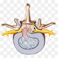 腰突腰椎间盘突出
